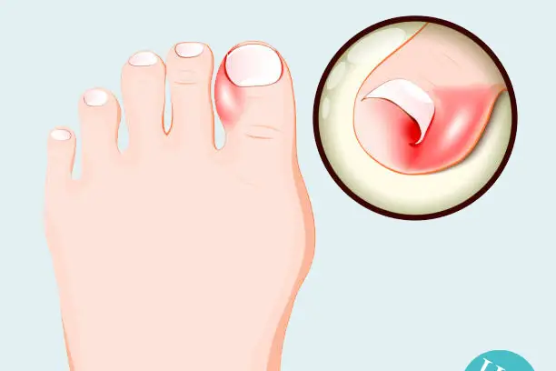 Ingrown Toenails