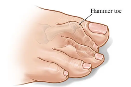 Hammertoes